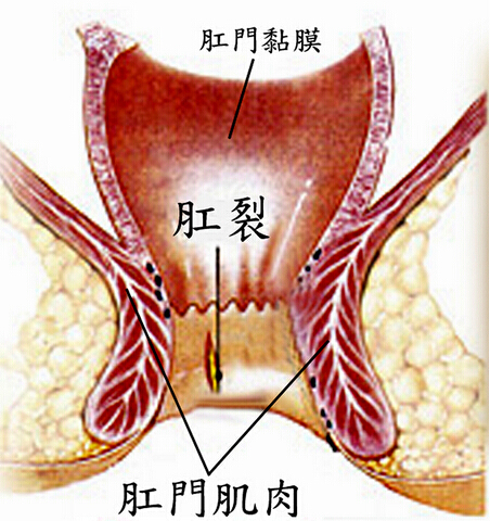 【危害】肛裂的危害有哪些？